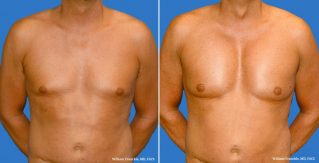 Man Boobs? Consider Male Breast Reduction - William Franckle MD FACS